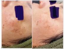 ヴィオラ(Viola)の雰囲気（ハーブピーリングでシミケア♪剥離調節可◎ ボディハーブも有り）