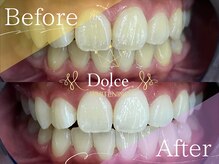 ドルチェ(Dolce)/ビフォーアフター
