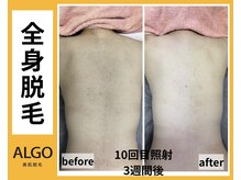 アルゴ 山口店(ALGO)/全身脱毛