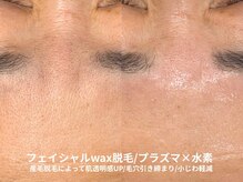 ピブ(pib.)/最後にプラズマで毛穴引き締め！