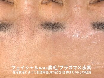 ピブ(pib.)/最後にプラズマで毛穴引き締め！