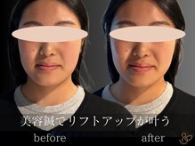 チョコバリ 恵比寿店(chocobari)/小顔リフトアップ（美容鍼）20代