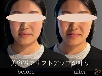 チョコバリ 恵比寿店(chocobari)/小顔リフトアップ（美容鍼）20代