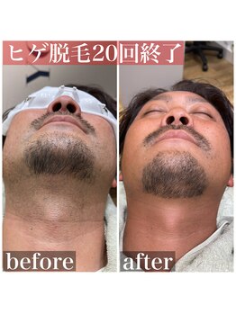 ヘアーズヨシオカ(HAIR'S YOSHIOKA)/#ヒゲ脱毛ビフォーアフター