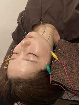 グランツ 堀江店(GLANZ)/美容鍼