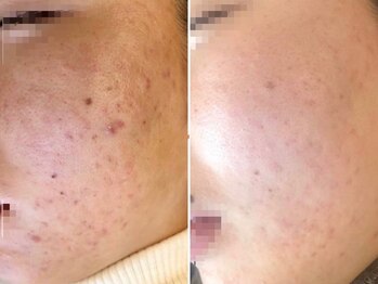 リッチ(Rich+)/プラズマシャワー