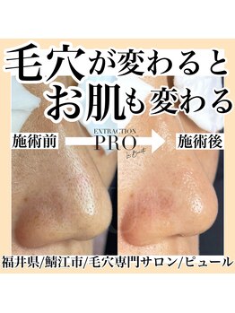 ピュール 鯖江店(PUR)/毛穴サロン/毛穴ケア/毛穴洗浄