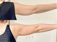 脂肪冷却×筋肉増強３ヶ月！大好きなお酒も飲んじゃってます♪