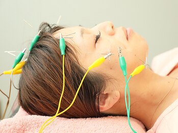 ハリ リリー カニエの写真/高技術の美容鍼で《変化が目に見える！》スゴ腕の鍼灸師による独自の手技で小顔・むくみ・たるみ改善♪