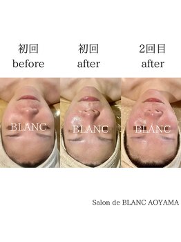サロン ド ブラン アオヤマ(Salon de BLANC AOYAMA)/BLANC式小顔コース