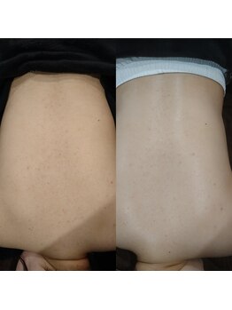 ボーソリューション(Beau-Solution)/【20代　背中肌荒れケア】