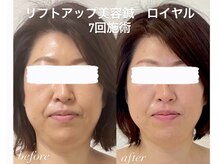 めい鍼灸院の雰囲気（極細で痛みの少ない鍼を使用。電気鍼で表情筋をしっかり引き締め）
