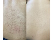 ソリッジ肌管理室/背中ニキビ、ハーブピーリング