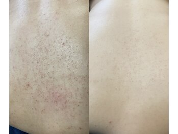 ソリッジ肌管理室/背中ニキビ、ハーブピーリング