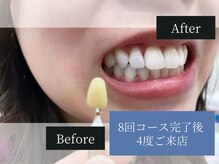 ホワイトニングカフェ 中野店(WhiteningCafe)/◎歯のホワイトニング施術写真◎