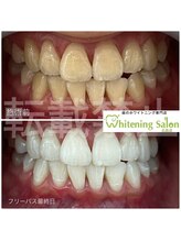 ホワイトニングサロン 広島店&nbsp;24回数券 