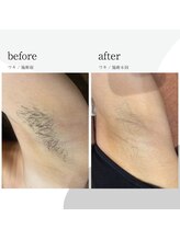 コンフォート ミヤ(comfort miya)/ワキ脱毛before/after