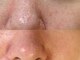 ウノ アッベリーナ(UNO × abbel'lina)の写真/毛穴を隠す毎日から卒業！開き毛穴・黒ずみ毛穴にアプローチ！自信が持てる、つるんと滑らかな肌へ♪