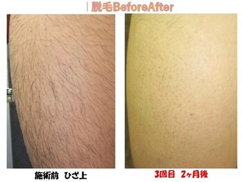 ピービー(PB)/脱毛