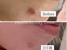 ホーミー(Homie)/ニキビ改善、赤みニキビ改善