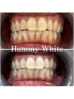 ハミーホワイト(Hammy White)/高濃度ジェルホワイトニング