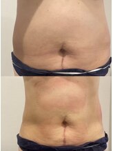 プリマルーチェ/プレミアムお腹プログラム