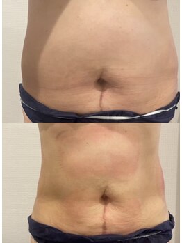 プリマルーチェ/プレミアムお腹プログラム