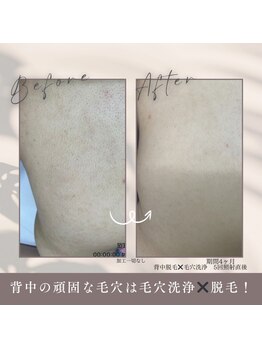 モアトゥインクル 福山宮通り店(MORE twinkle)/全身脱毛もお任せ下さい！