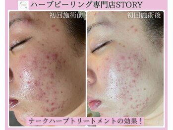 ストーリー(STORY)/ハーブピーリング専門店STORY