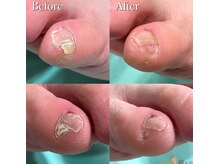 巻き爪補正店 豊田店/【副爪ケア】