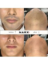 ナークス(NARX)/【ヒゲ脱毛】ビフォーアフター