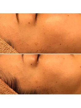 ファビリス 天王寺店(FAVILIS)/ACトリートメント1回/30代