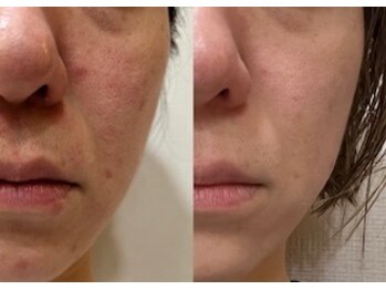 アルバ 広島店(ALBA)/【肌荒れ】水光ピーリング