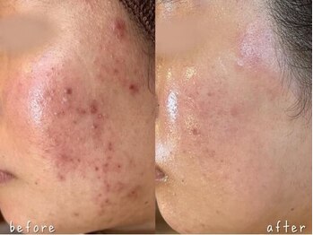 オリーブ コクブンジ(Olive kokubunji)/ハーブピーリング｜ニキビケア