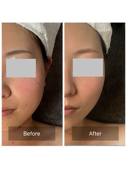 カノン(Kanon)/【ニキビ凸凹】レモンボトル2回