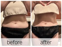 エステサロン ジュエル 高松レインボー店(JEWEL)/脂肪燃焼パック