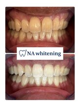 NAホワイトニング 船橋店/ホワイトニングビフォーアフター