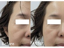 マインドール/目の周りのシワ軽減！