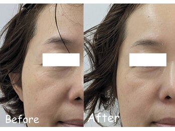 マインドール/目の周りのシワ軽減!