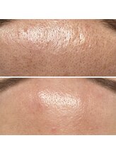 メンズエフディ ファウンデーション(メンズFD)/顔脱毛×毛穴クレンズ