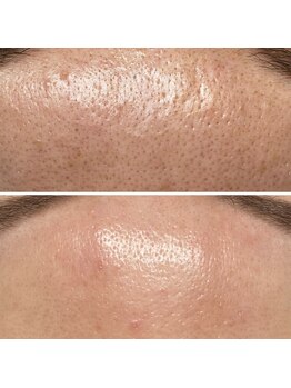 メンズエフディ ファウンデーション(メンズFD)/顔脱毛×毛穴クレンズ