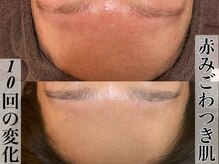 ビジュープラス 広島店(Bijou+)/【20代/赤み・ごわつき】