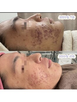 ニキビケア研究所 所沢店/ニキビケアはプロにお任せ