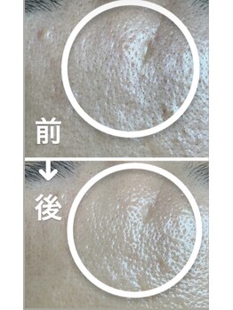 リンカ(Rinca)/毛穴の黒ずみ徹底除去！おでこ編