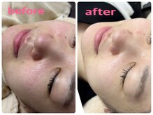 ラウレア 松山店(LAULEA)/ハーブピーリング　before/after