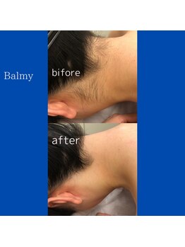 バルミー(Balmy)/うなじの施術
