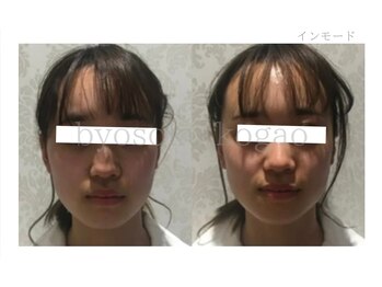 メディカルエステ 新宿店/＊インモード症例写真＊