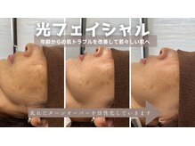 シャイニーの雰囲気（【光フェイシャル】若々しい肌を取り戻す！肌悩みを改善！）