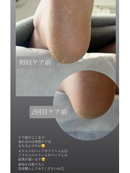 フットミー(foot mii)/ケア前でも明確なかかと
