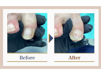 巻き爪補正店 錦糸町店/【巻き爪補正】